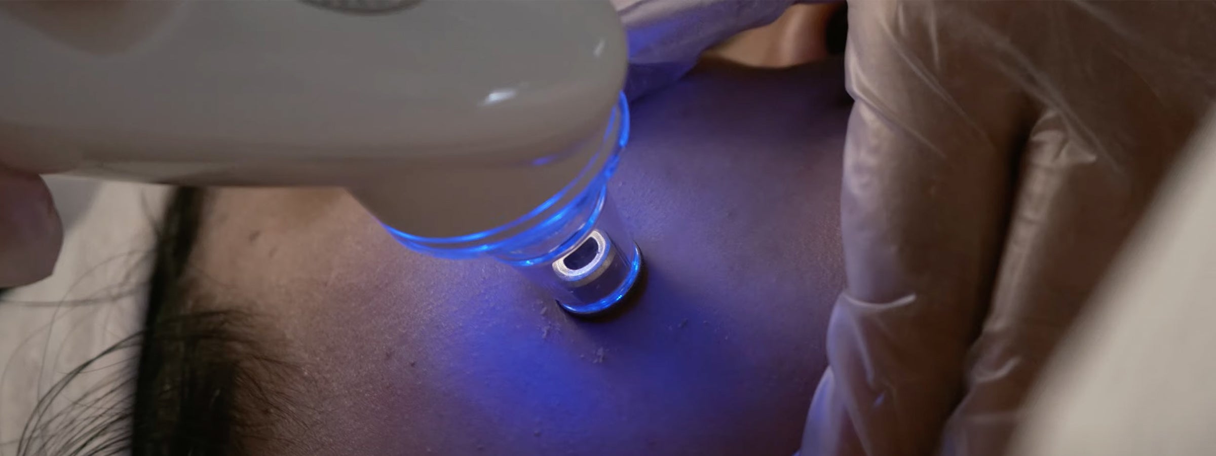 Microdermabrasion Machines